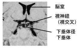 前後像（冠状断）の下垂体