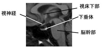 側面像（矢状断）の下垂体
