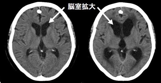 前後像（冠状断）の下垂体