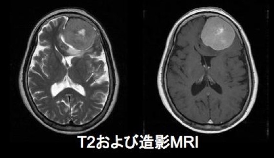 髄膜腫